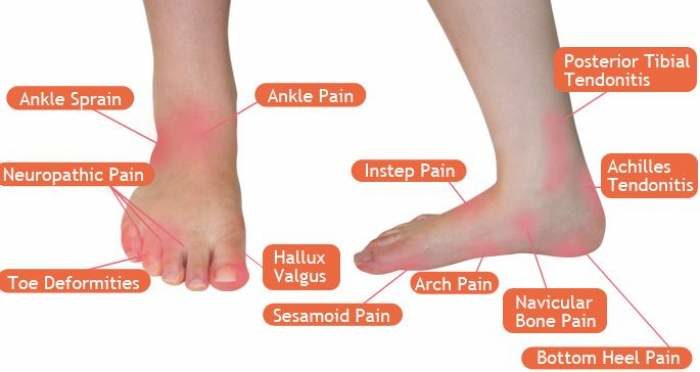  DIAGRAM Diagram Foot Pain By Location MYDIAGRAM ONLINE